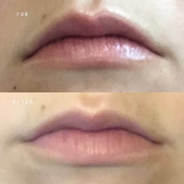 nedadvendt mundvige før og efter botox behandling